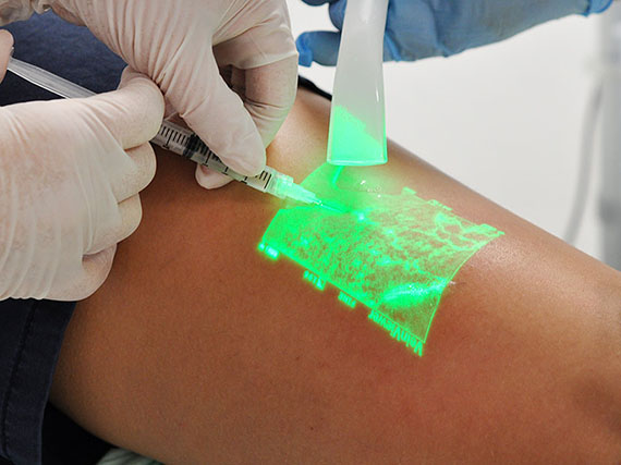 Лазерное удаление сосудов на теле и ногах с криосклеротерапией CLaCS
